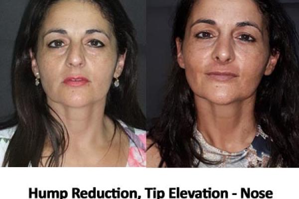 Hump Reduction