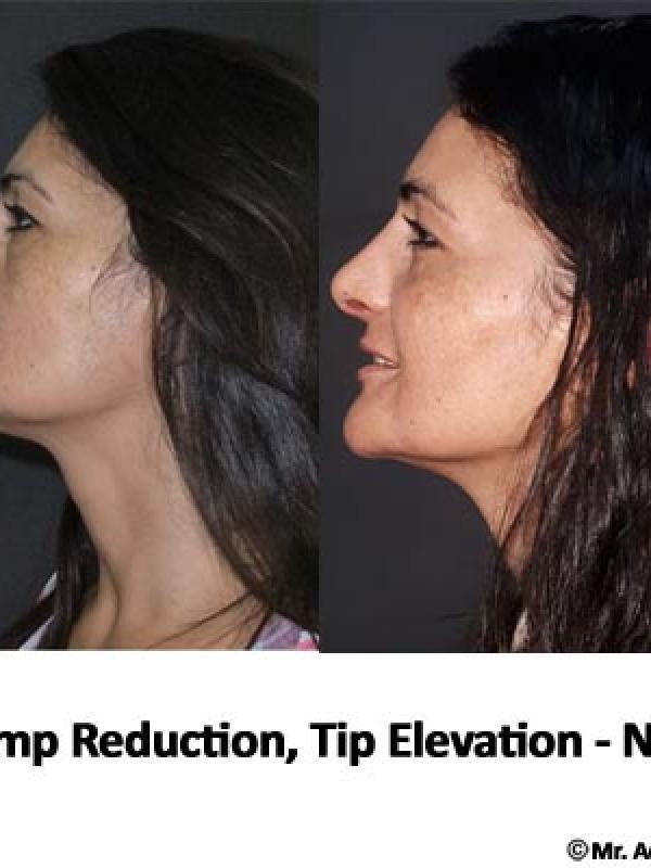Hump Reduction