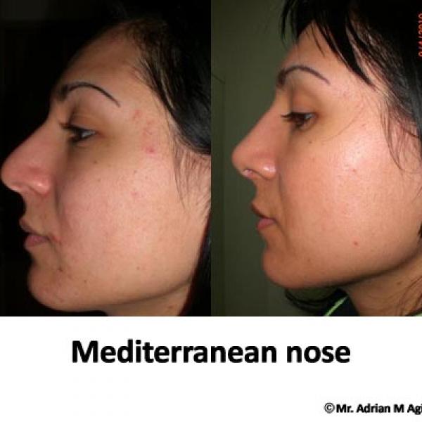 Mediterranean Nose