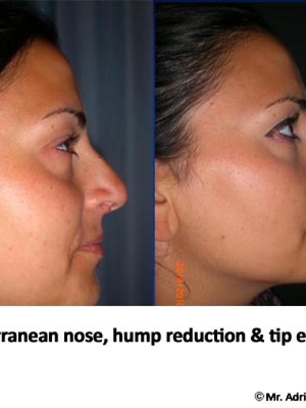 Mediterranean Nose