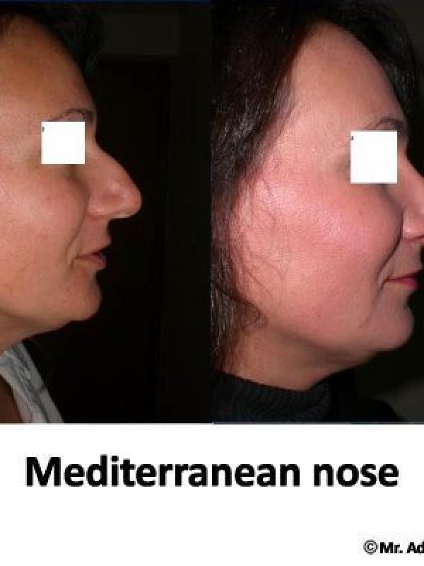 Mediterranean Nose