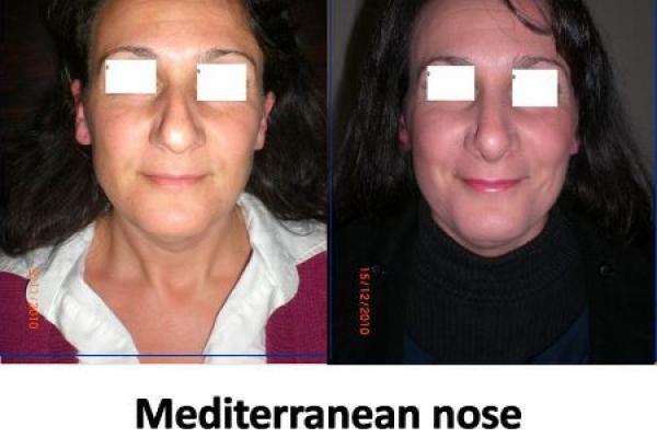 Mediterranean Nose