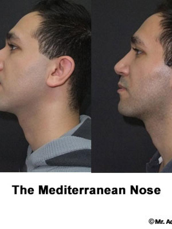 Mediterranean Nose