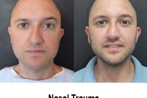 Nasal trauma-deviated nose