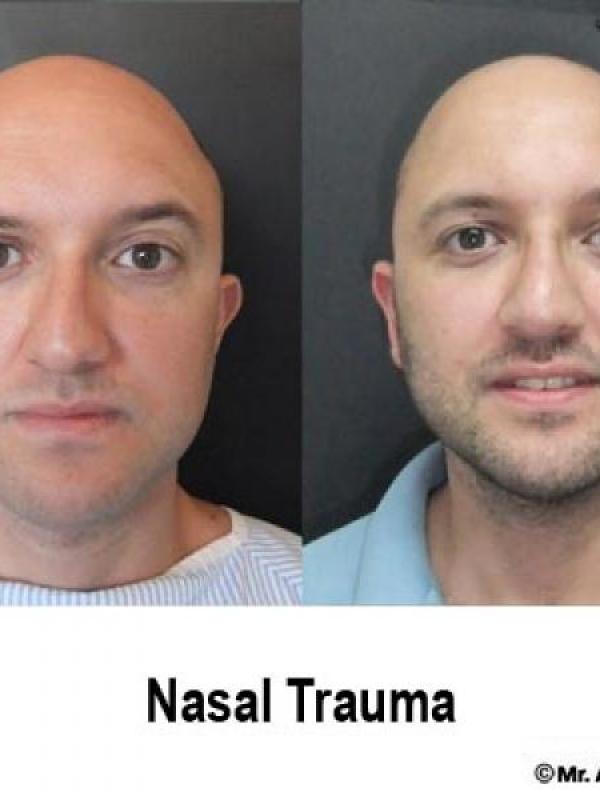 Nasal trauma-deviated nose