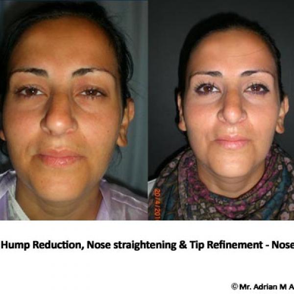 Nose Hump Reduction/Removal