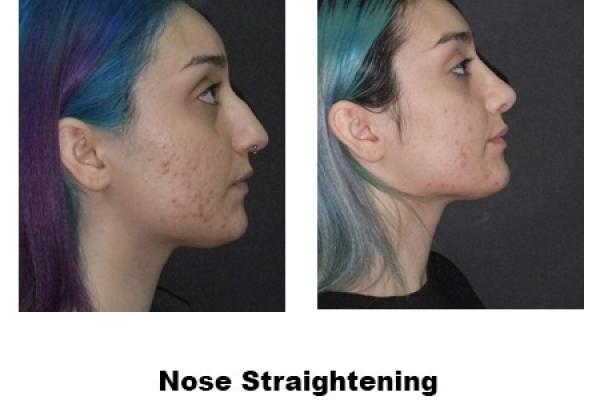 Nose Straightening