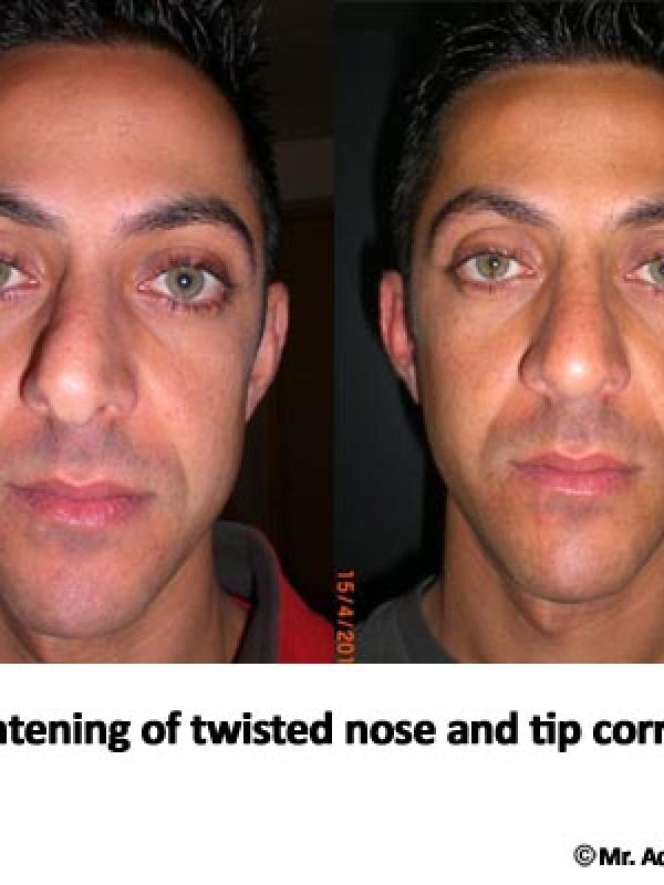 Nose Tip Correction