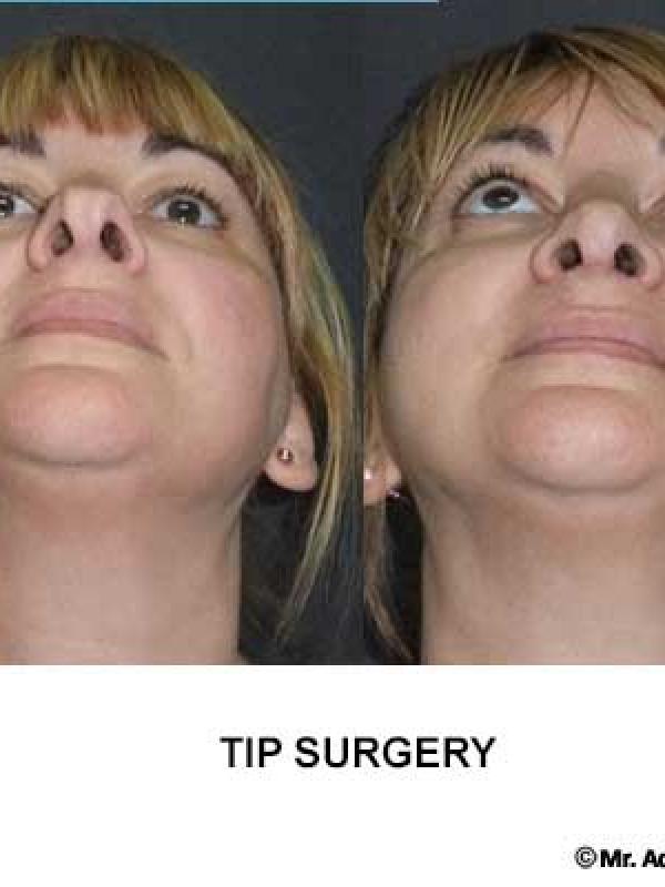 Nose Tip Correction