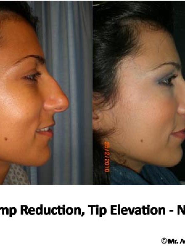 Nose Tip Elevation