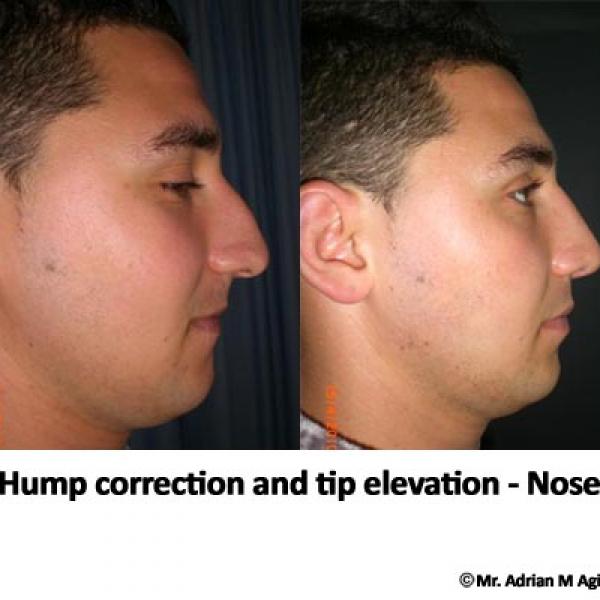 Nose Tip Elevation