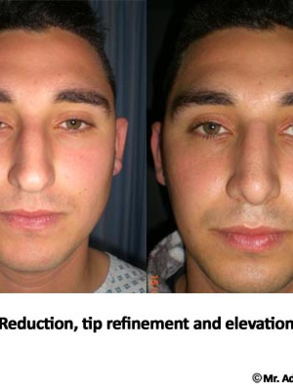 Nose Tip Elevation