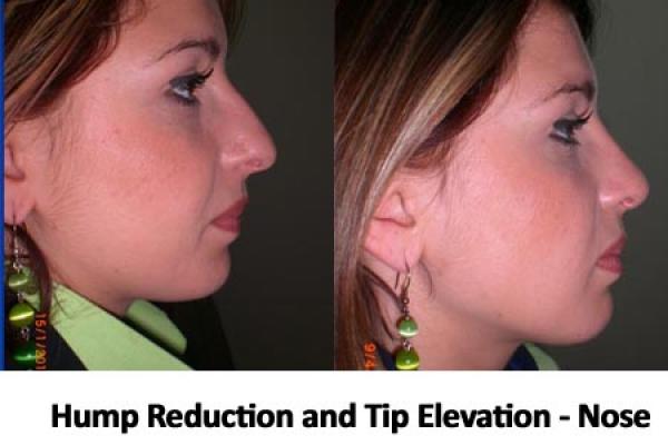 Nose Tip Elevation