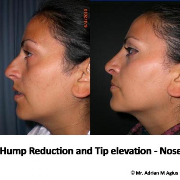 Nose Tip Elevation
