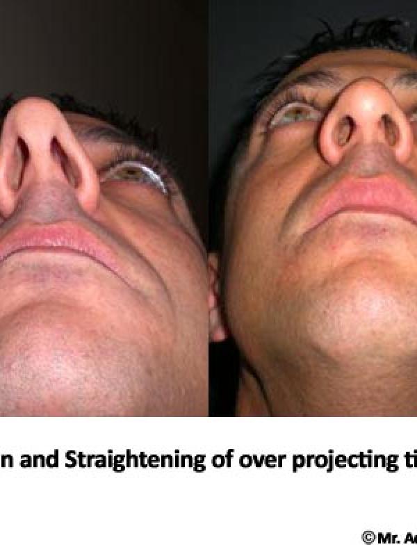Nose Tip Reduction