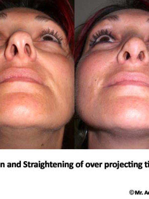 Nose Tip Reduction