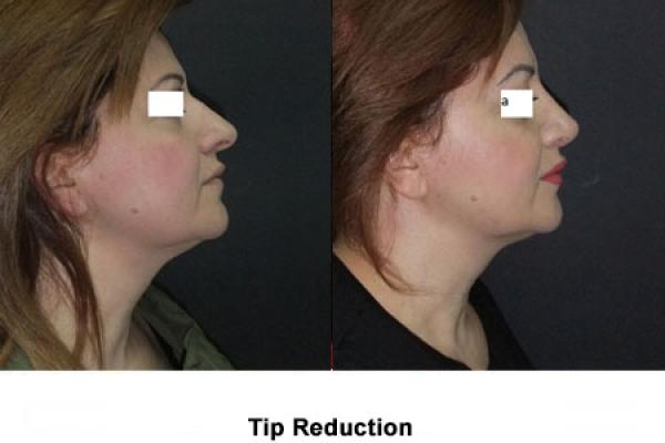 Nose Tip Reduction