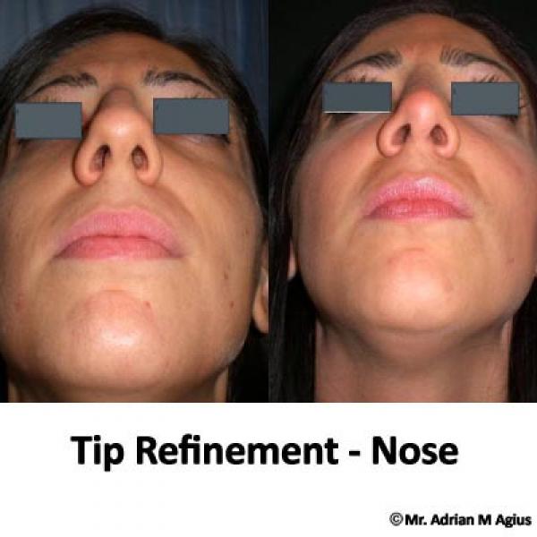 Nose Tip Refinement 