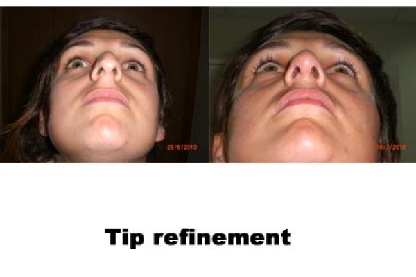 Nose Tip Refinement 