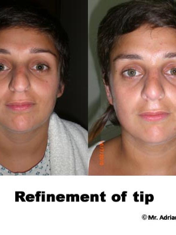 Nose Tip Refinement 