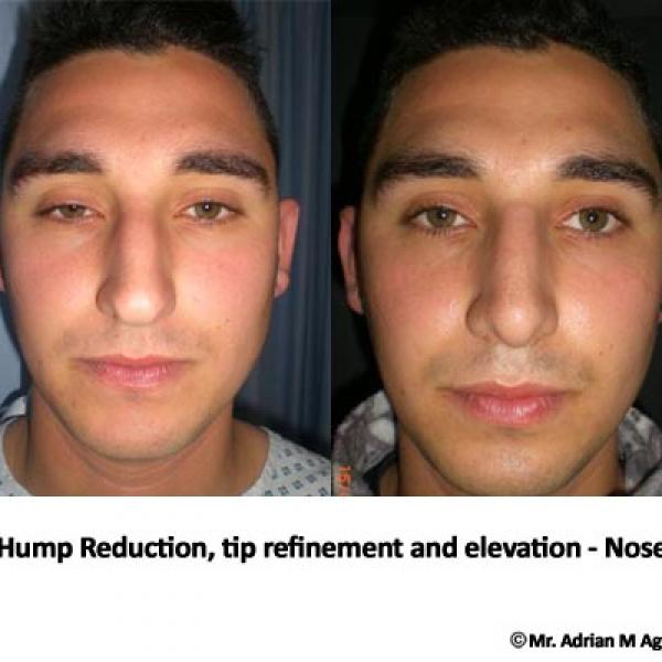 Nose Tip Refinement 