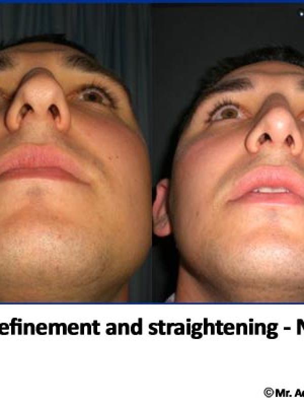 Nose Tip Refinement 