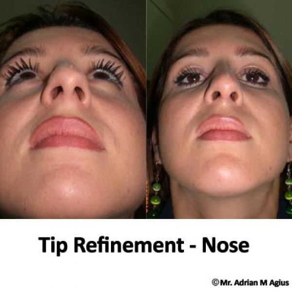 Nose Tip Refinement 