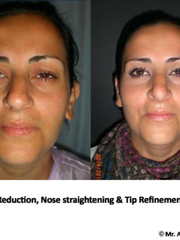 Nose Tip Refinement 