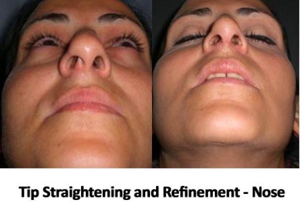Nose Tip Refinement 