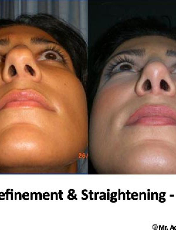 Nose Tip Refinement 