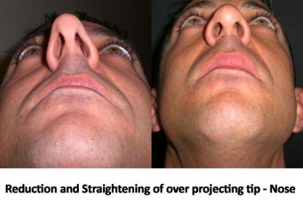 Nose Tip Straightening