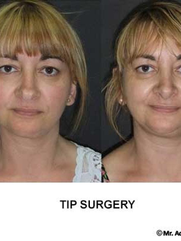 Nose Tip Surgery