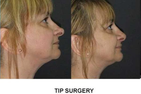 Nose Tip Surgery