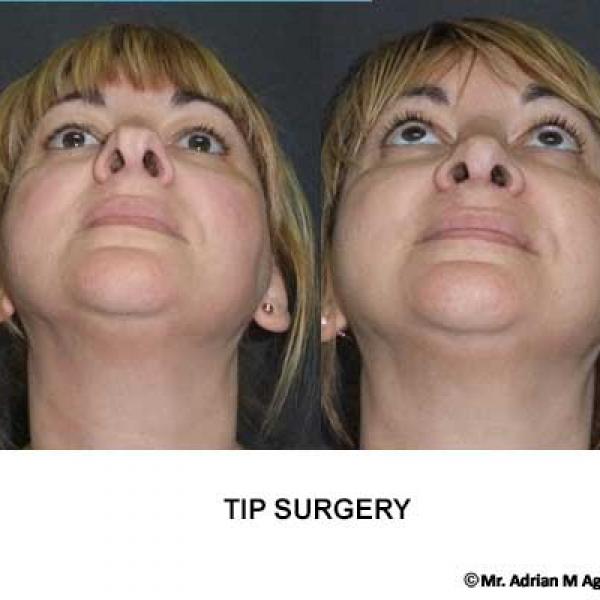 Nose Tip Surgery