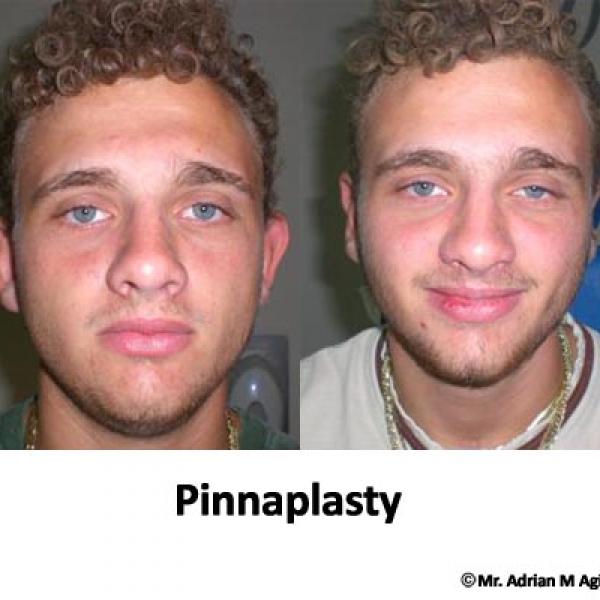 Pinnaplasty Surgery