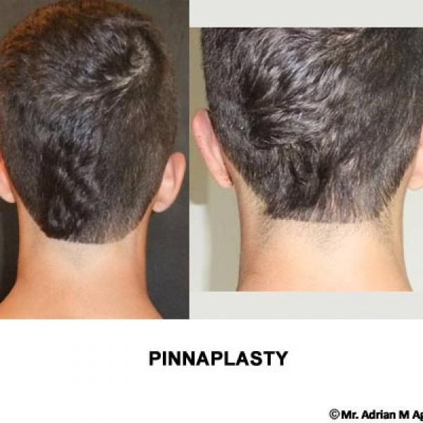 Pinnaplasty Surgery